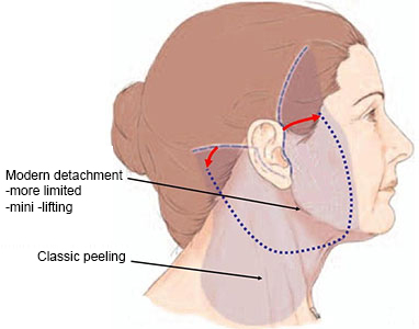 neck lift tunisia